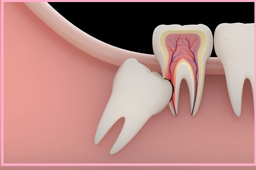 Cần làm gì khi bị sưng nướu răng khôn?